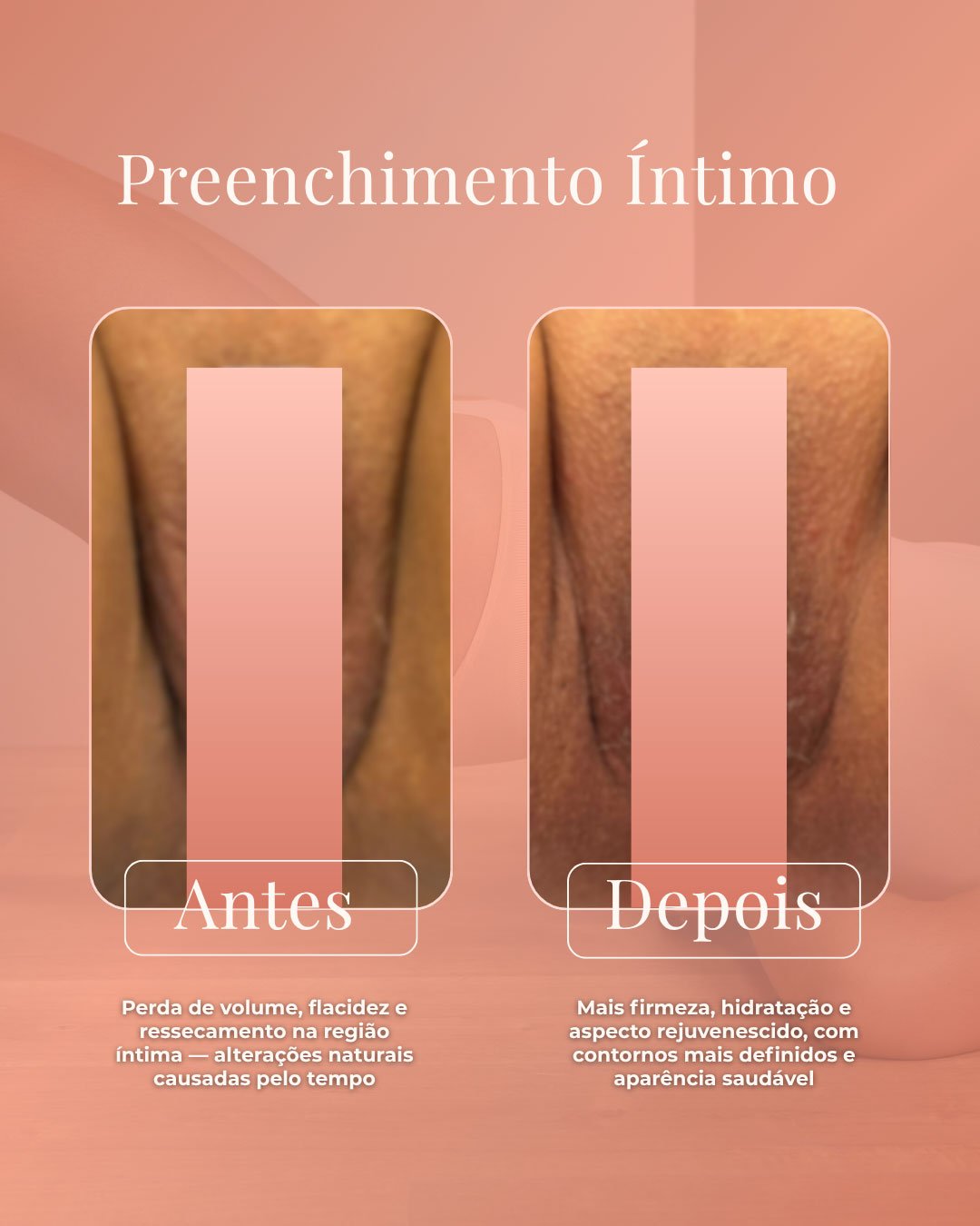 antes-depois-preenchimento-intimo-procedimentos-intimos-femininos-clinica-plenus-madureira-rio-de-janeiro